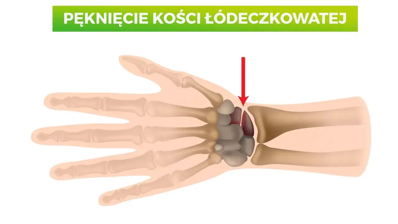 Ilustracja pokazuje pęknięcie kości łódeczkowatej nadgarstka, zaznaczone czerwoną strzałką.