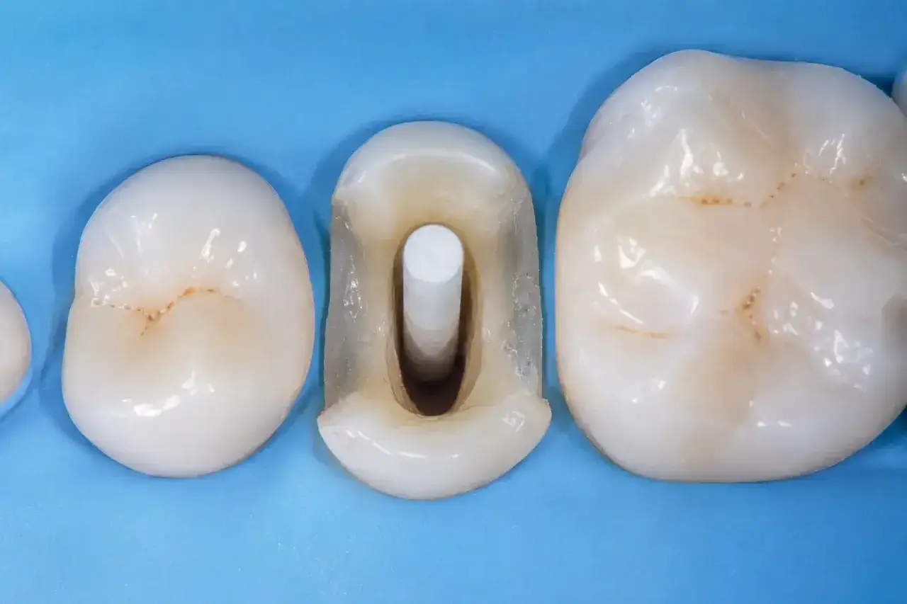 Dettaglio di un impianto perno dente, con il perno inserito nel canale radicolare preparato, pronto per il restauro.
