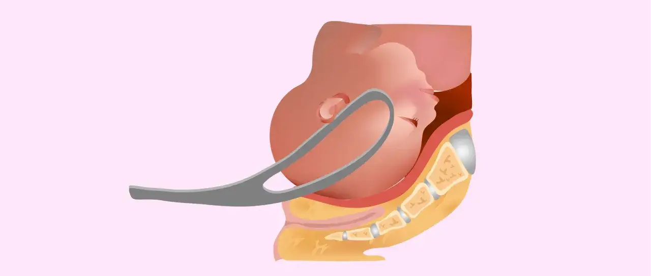 Uso di forcipe per assistere il parto, con il bambino posizionato nel bacino materno.