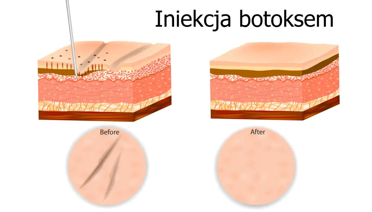 Porównanie toksyny botulinowej Botox i Azzalure