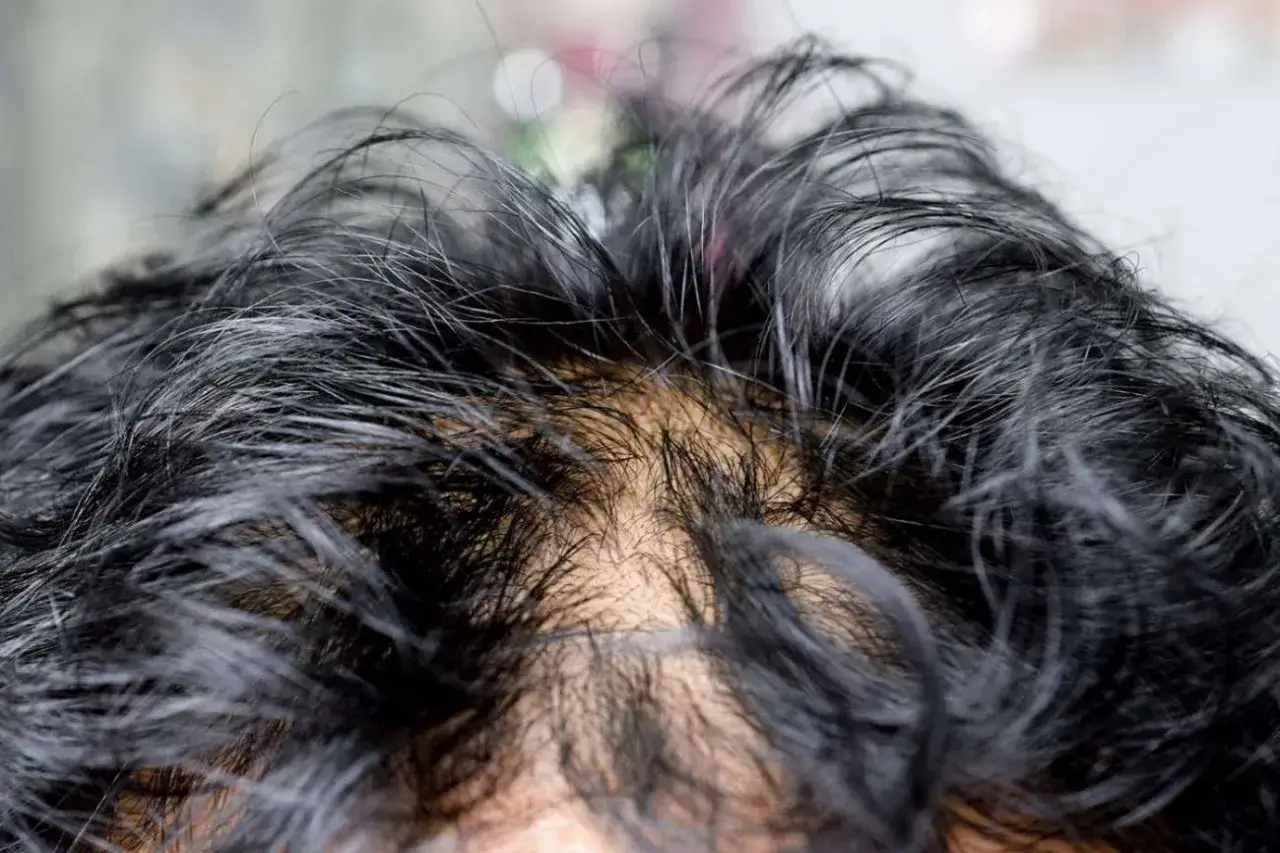 Primo piano dei capelli scuri e lucidi di una bambina di 10 anni, che mostrano un po' di sebo.