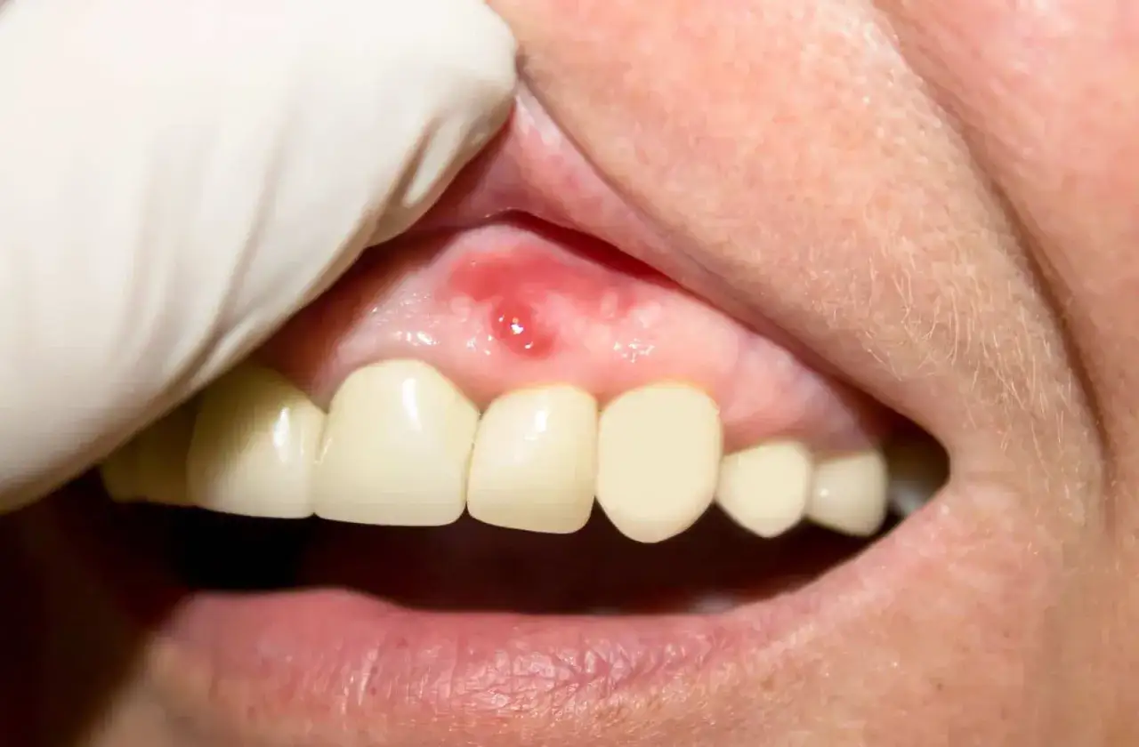 Una piccola lesione rossa e infiammata, un'afta gengiva, visibile vicino ai denti.