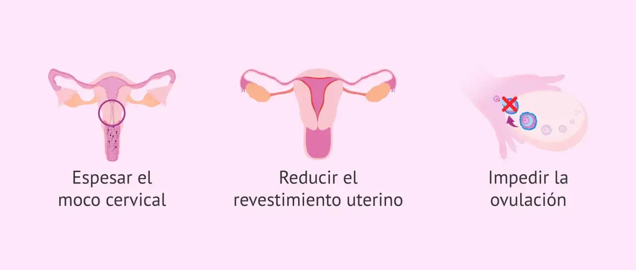 Ilustraci&oacute;n muestra c&oacute;mo el diu hormonal espesa el moco cervical, reduce el revestimiento uterino e impide la ovulaci&oacute;n.