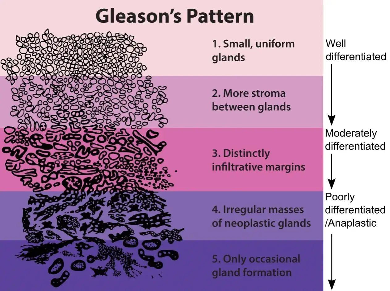 Wykres Gleason's Pattern ilustruje stopnie złośliwości raka prostaty. Zły wynik biopsji prostaty może oznaczać niski stopień zróżnicowania.