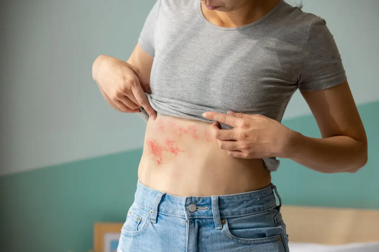 Kobieta pokazuje zaczerwienioną skórę na brzuchu, objaw chorób autoimmunologicznych skóry.