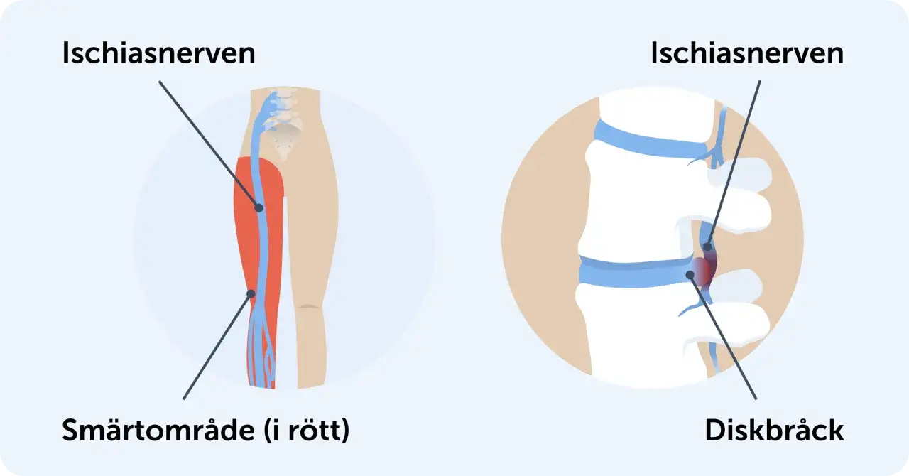 Illustration av ischiasnerven och diskbråck. Smärtområde i rött längs benet kan orsakas av ett diskbråck som ger kramp i rumpan.