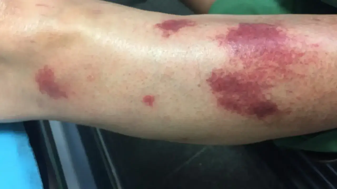 M&uacute;ltiples manchas rojas en la pierna, algunas grandes y otras peque&ntilde;as, sugieren un posible hematoma o erupci&oacute;n cut&aacute;nea.