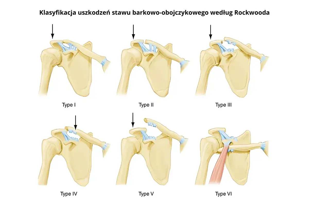 Ilustracja klasyfikacji uszkodzeń stawu barkowo-obojczykowego. Widać, jak obojczyk wystający zmienia swoje położenie w zależności od typu urazu.