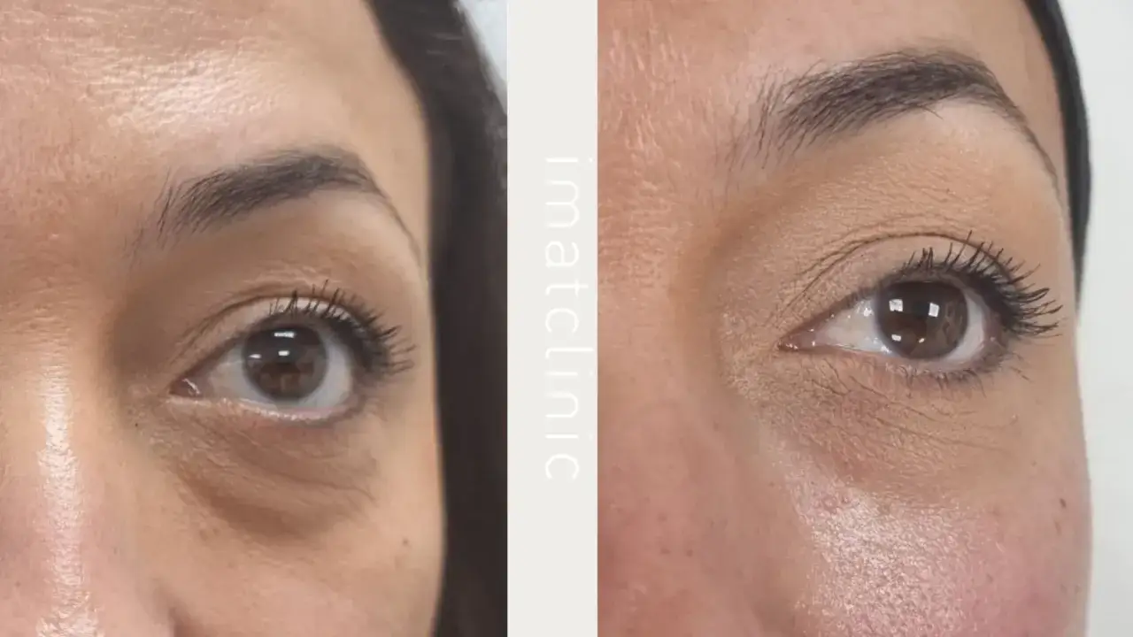 Antes y después de un tratamiento para disimular las bolsas de los ojos. Se observa una piel más lisa y uniforme.