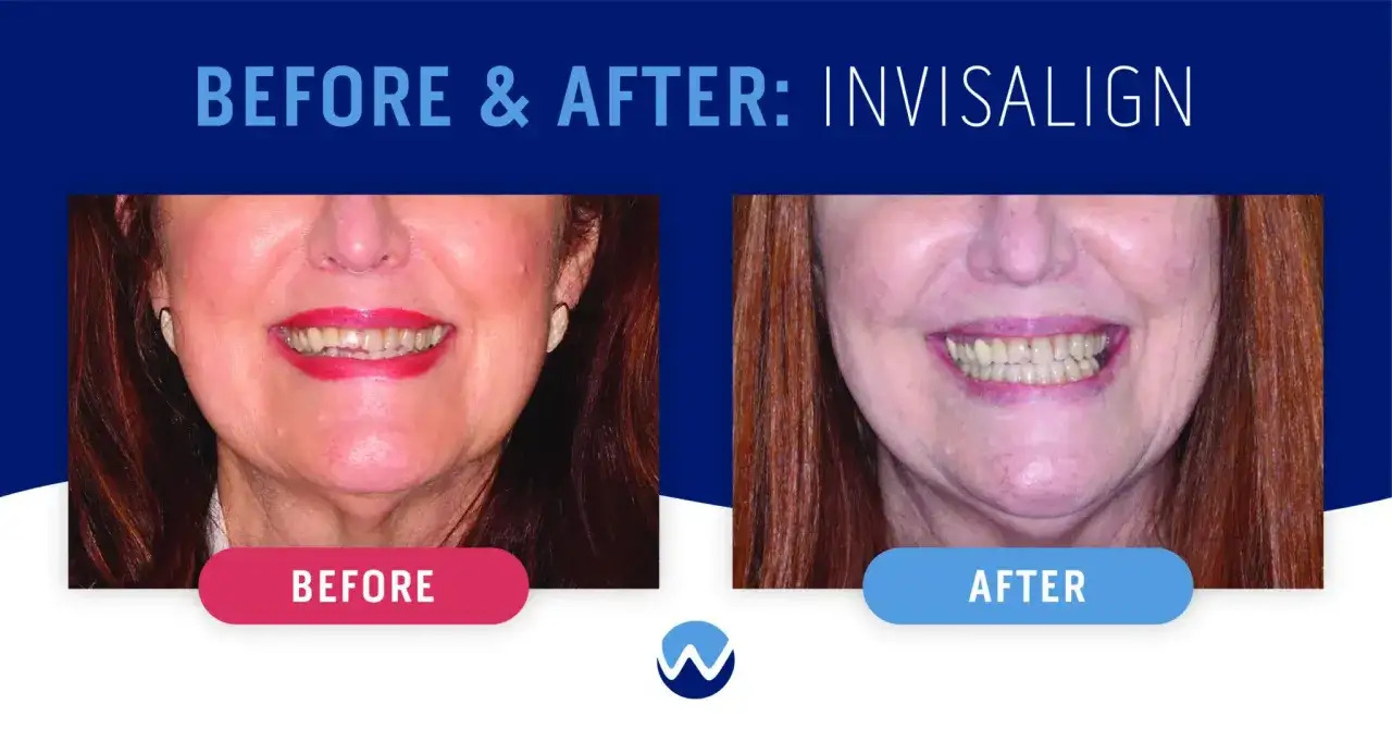 Antes y después de Invisalign. La pregunta de cuanto tiempo dura la ortodoncia invisible se responde con resultados visibles.