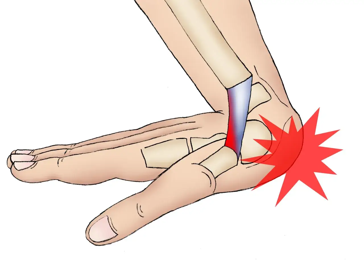 Illustration zeigt einen verletzten Handgelenkbereich mit roter Schmerzmarkierung. Typische prellung handgelenk symptome sind Schmerz und Schwellung.