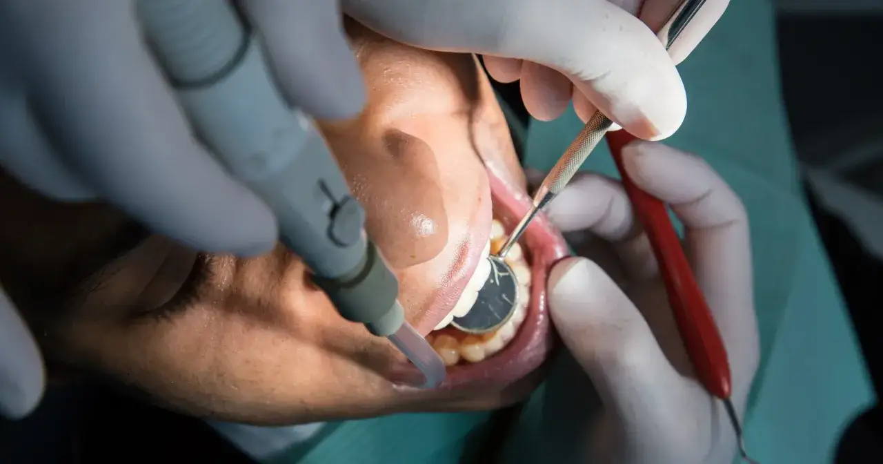 Dentysta pracuje nad zębami pacjenta, używając narzędzi do wypełnienia ubytku. Widać, jak wygląda plomba w trakcie zakładania.