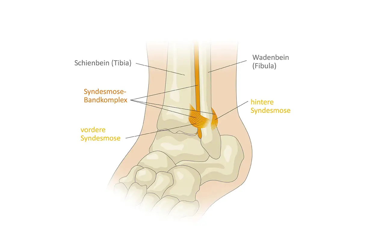 Anatomische Darstellung des oberen Sprunggelenks mit Schien- und Wadenbein sowie dem Syndesmose-Bandkomplex, der vordere und hintere Syndesmose umfasst.