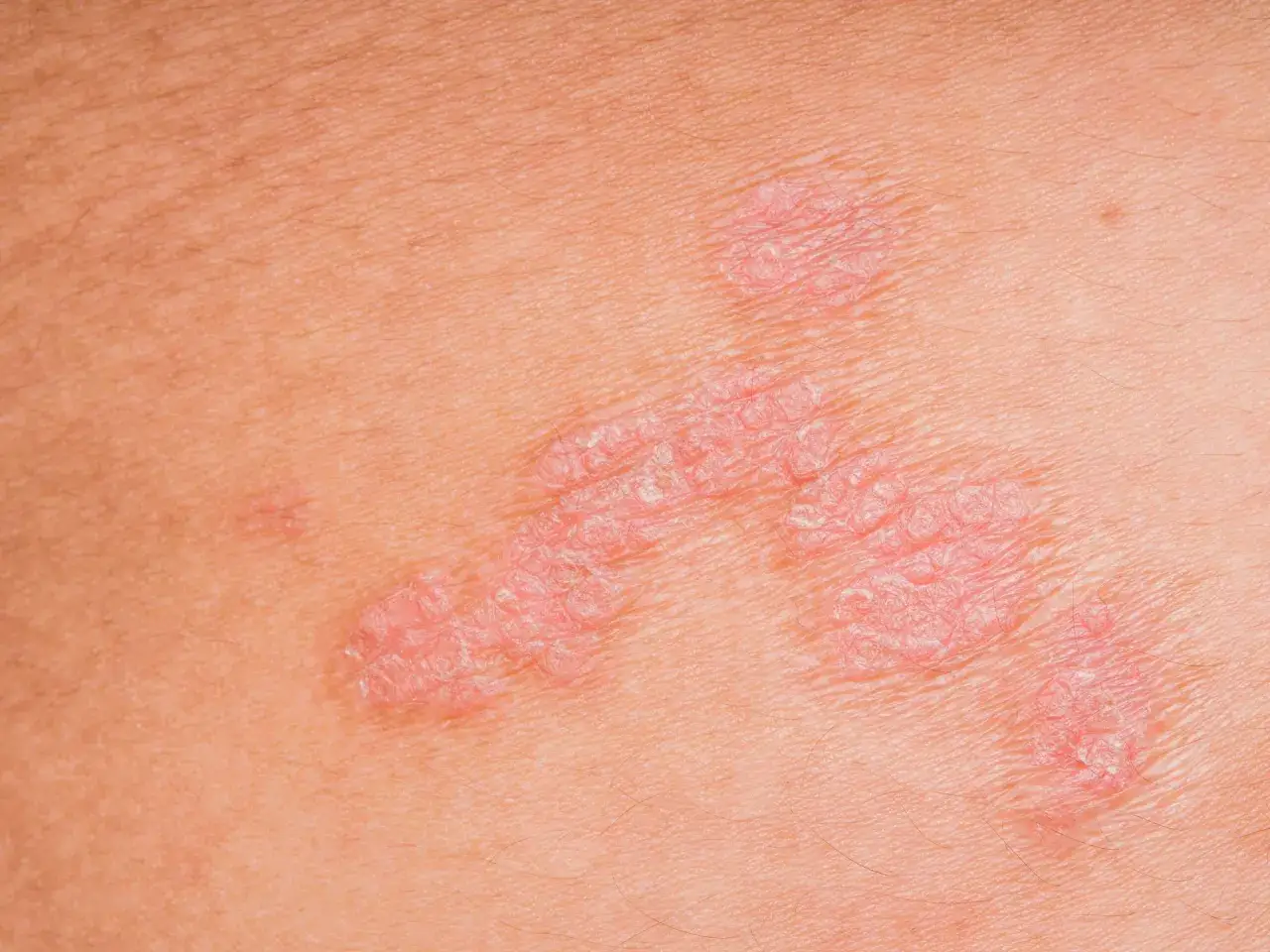 Nahaufnahme von schuppiger Haut, die auf Neurodermitis hindeutet. Rote, erhabene Stellen mit silbrig-wei&szlig;en Schuppen.