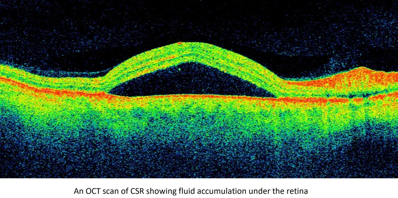 OCT mostra accumulo di liquido sotto la retina, indicativo di retinopatia da stress.