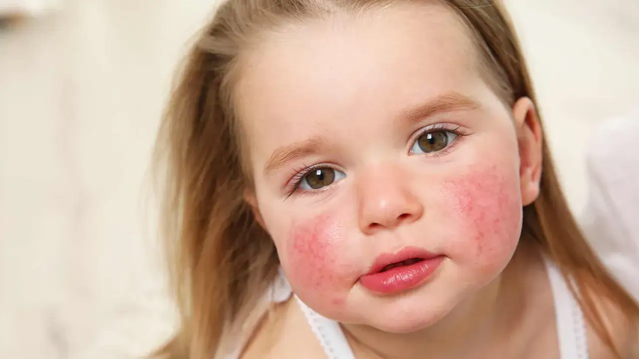 Primer plano de una ni&ntilde;a con mejillas enrojecidas, indicativo de piel at&oacute;pica.