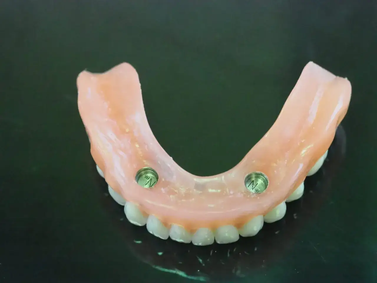 Dolna proteza overdenture z dwoma zatrzaskami na implantach, gotowa do przywrócenia pełnego uśmiechu.