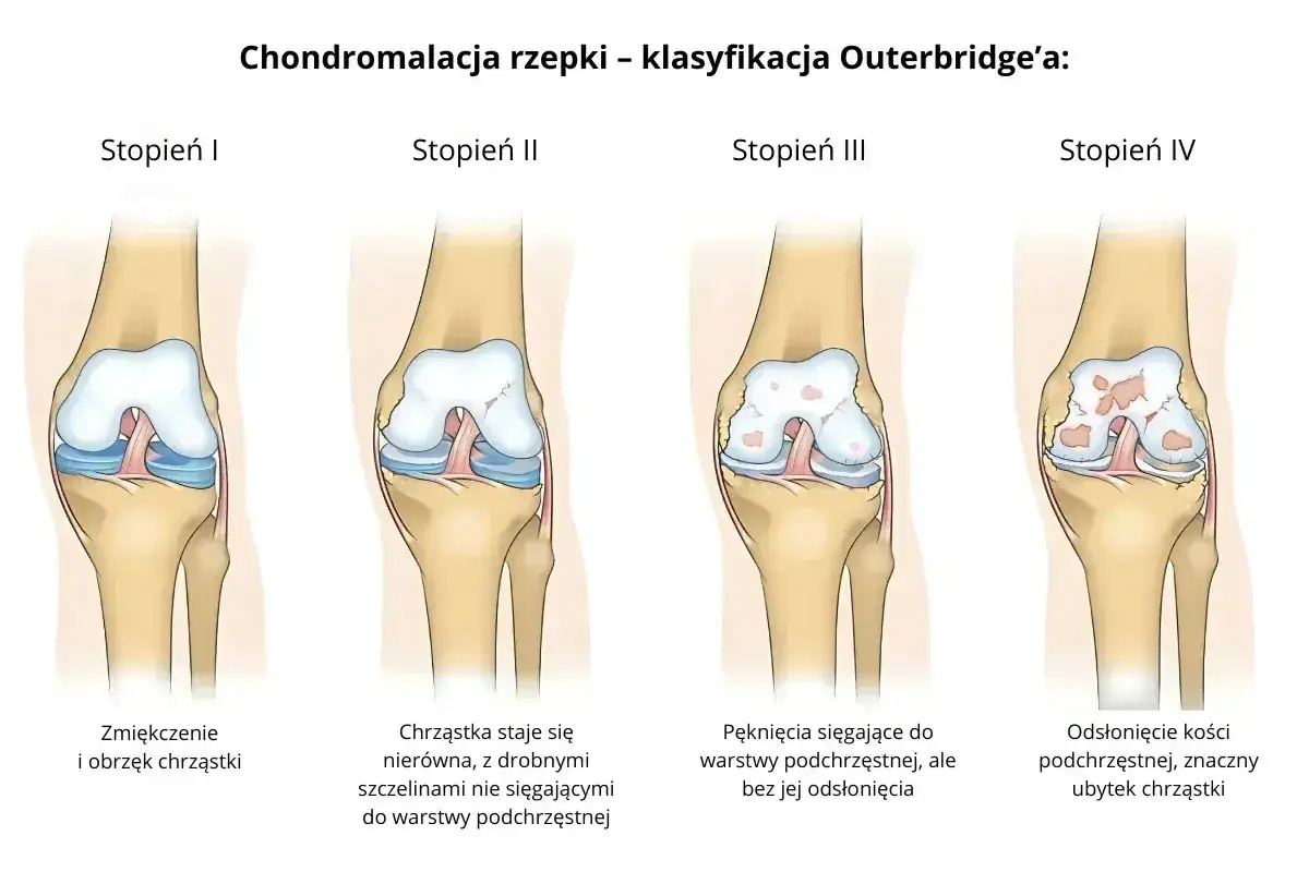 Klasyfikacja chondromalacji rzepki Outerbridge'a: stopień IV pokazuje odsłoniętą kość podchrzęstną i znaczny ubytek chrząstki.