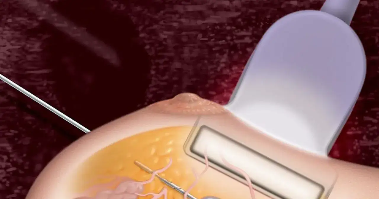 Ilustracja przedstawia biopsję mammotomiczną: igła biopsyjna pod kontrolą USG pobiera próbkę tkanki z piersi.