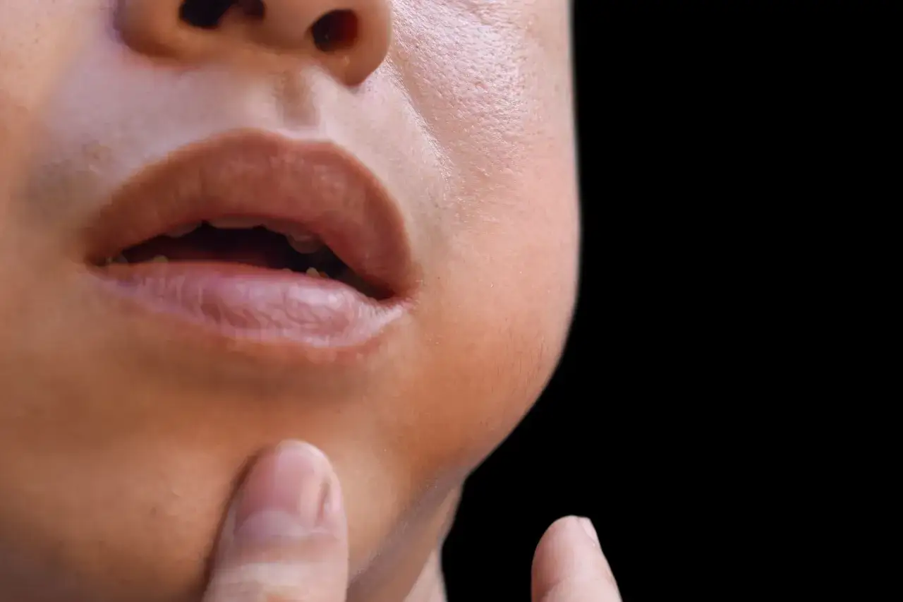 Nahaufnahme eines Gesichts mit geschwollener Wange, ein mögliches Symptom für Lymphstau im Gesicht.