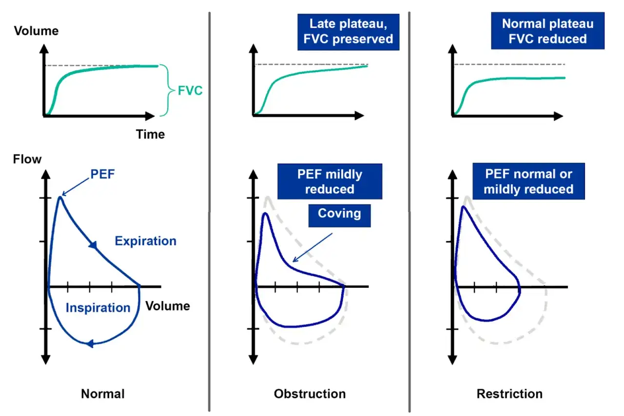 Vergleich von Lungenvolumen-Diagrammen: Normal, Obstruktion und Restriktion. Zeigt Fluss-Volumen-Kurven und Volumen-Zeit-Kurven.