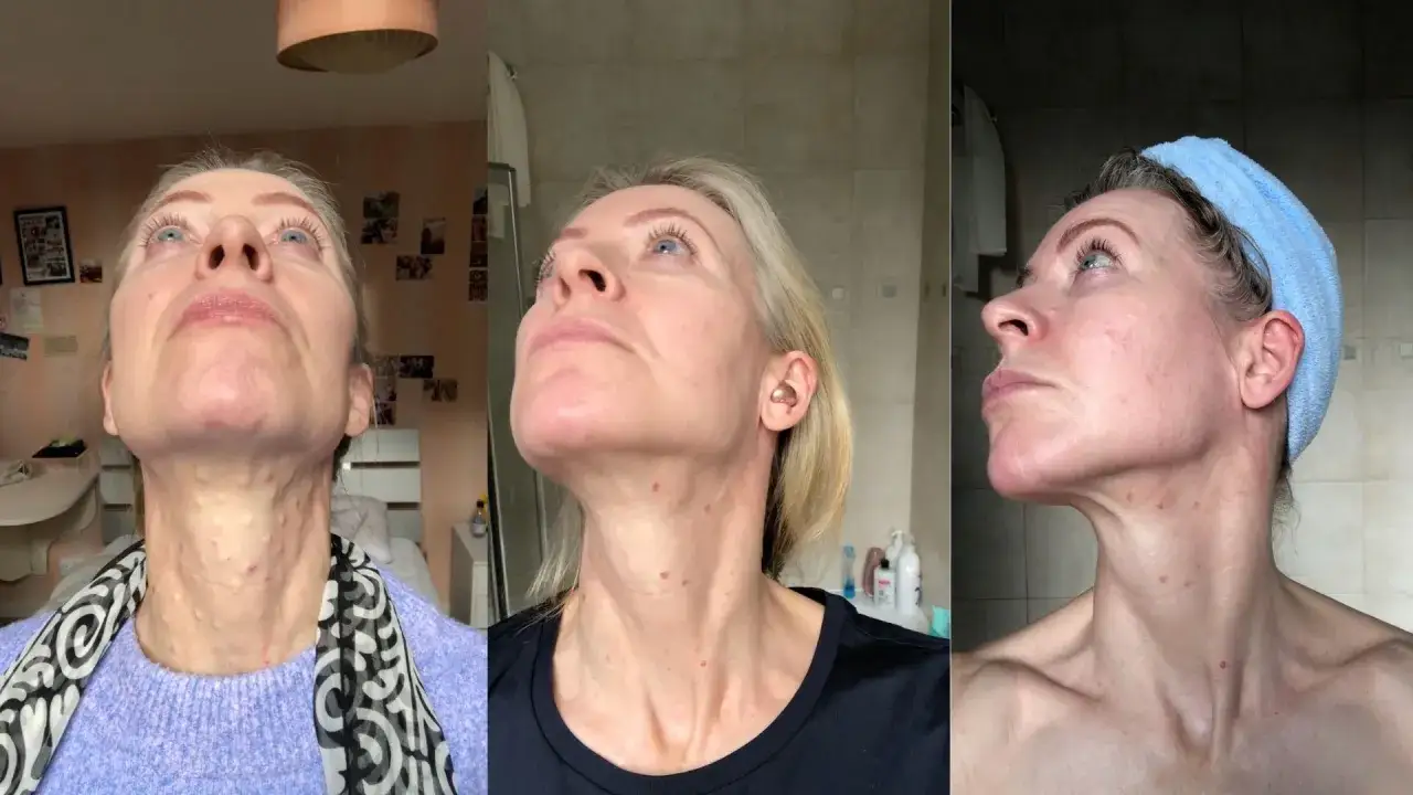 Kvinnas hals och ansikte före och efter profhilo behandling. Synliga injektionspunkter och hudförbättring.