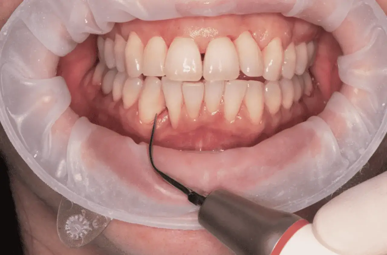 Dettaglio di una pulizia dei denti con uno strumento odontoiatrico. La durata di una pulizia dei denti varia.