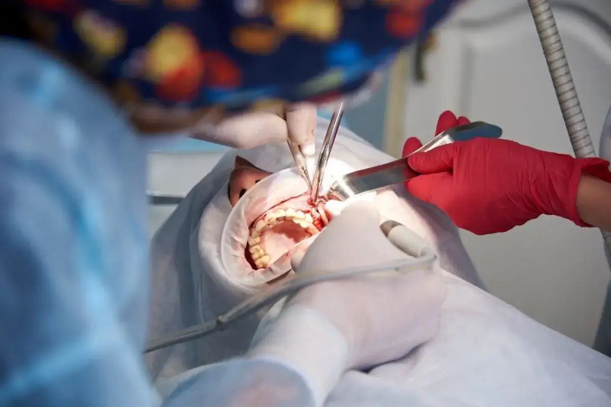 Procedimiento dental, posiblemente una elevación de seno maxilar. Opiniones de pacientes y doctores sobre esta cirugía.