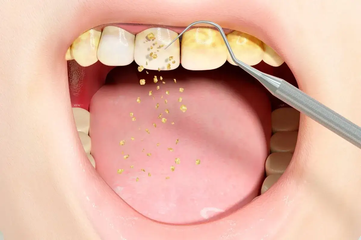 Brudne zęby z widocznym kamieniem nazębnym, usuwanym narzędziem dentystycznym.