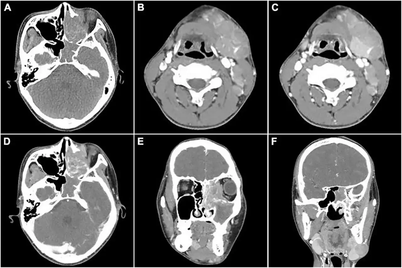 Sei scansioni TC mostrano un tumore che coinvolge il naso, i seni paranasali e il collo, compatibile con rabdomiosarcoma alveolare.