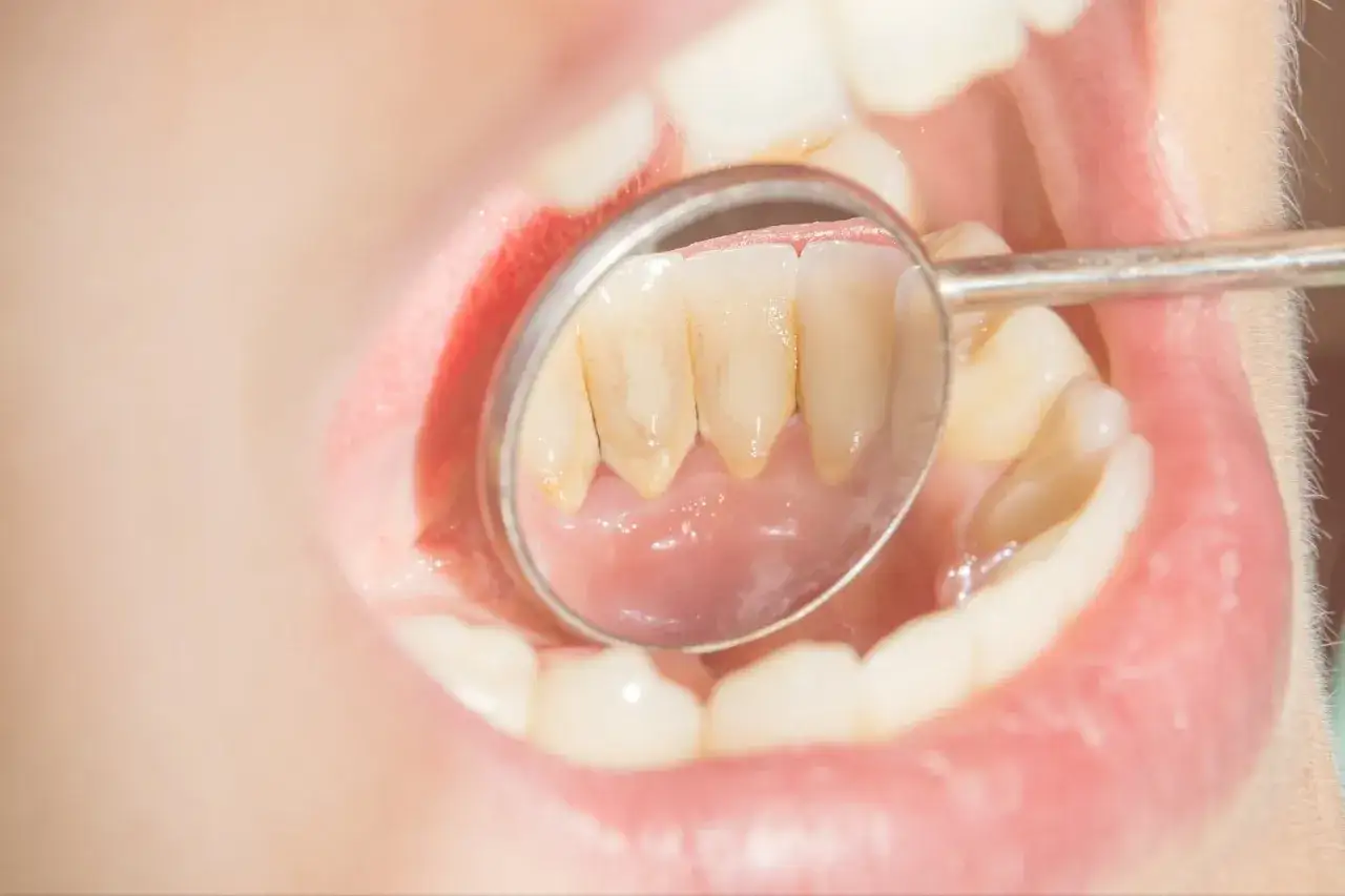 Widok zęba z kamieniem nazębnym w odbiciu lusterka dentystycznego. Dowiedz się, jak usunąć kamień z zębów.
