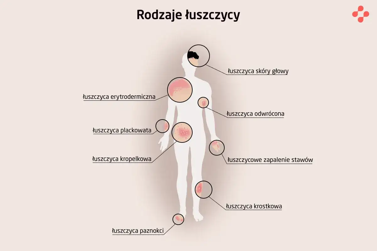 Ilustracja przedstawia różne rodzaje łuszczycy, w tym łuszczycę kropelkową, która objawia się małymi, czerwonymi plamkami na skórze.