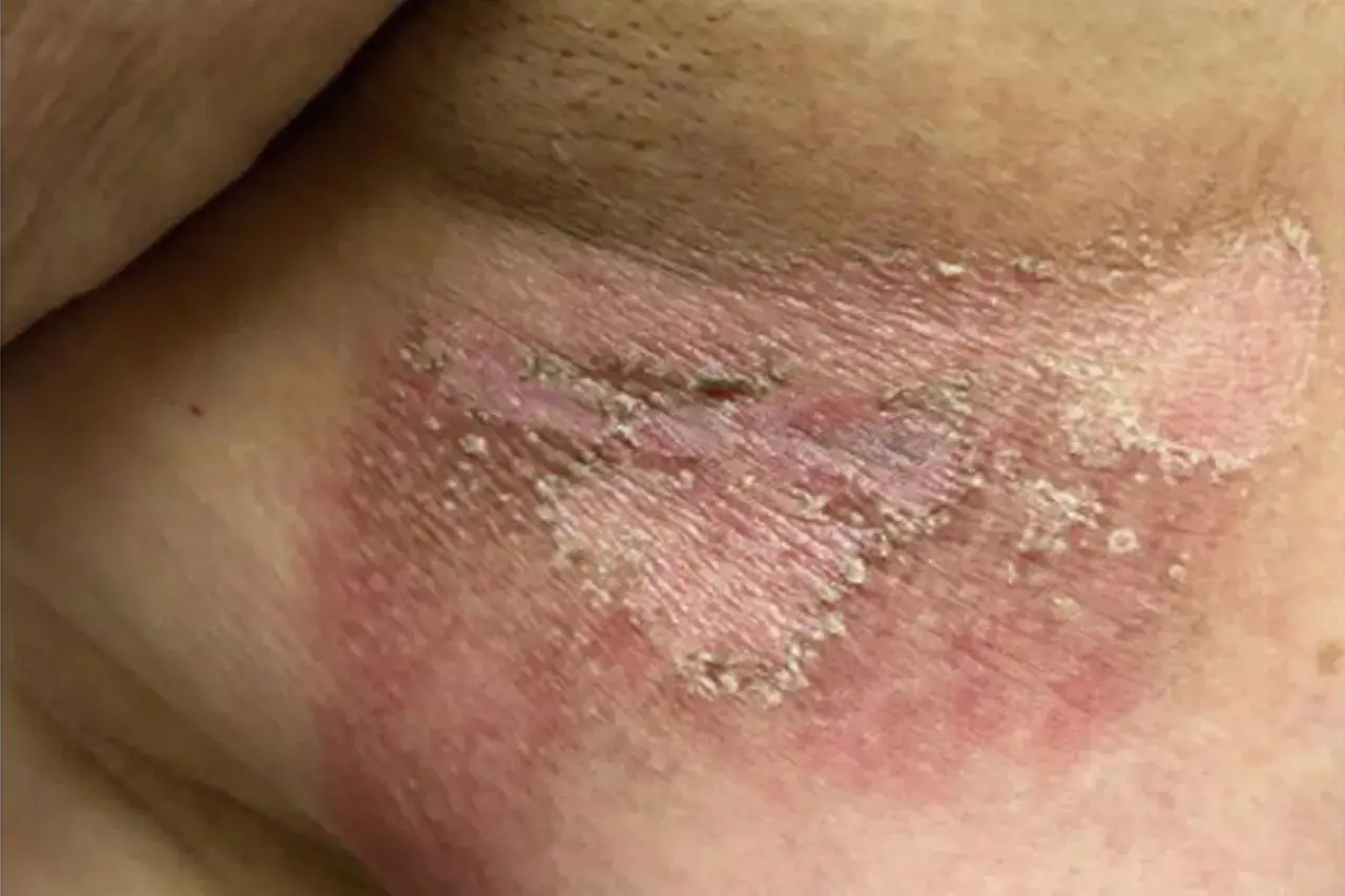 Peau irrit&eacute;e avec des rougeurs et des squames, possiblement li&eacute;e &agrave; la chimio et &agrave; des boutons.