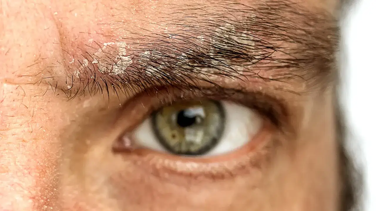 Gros plan sur un &oelig;il avec un sourcil qui gratte et p&egrave;le, r&eacute;v&eacute;lant une peau irrit&eacute;e et des squames.