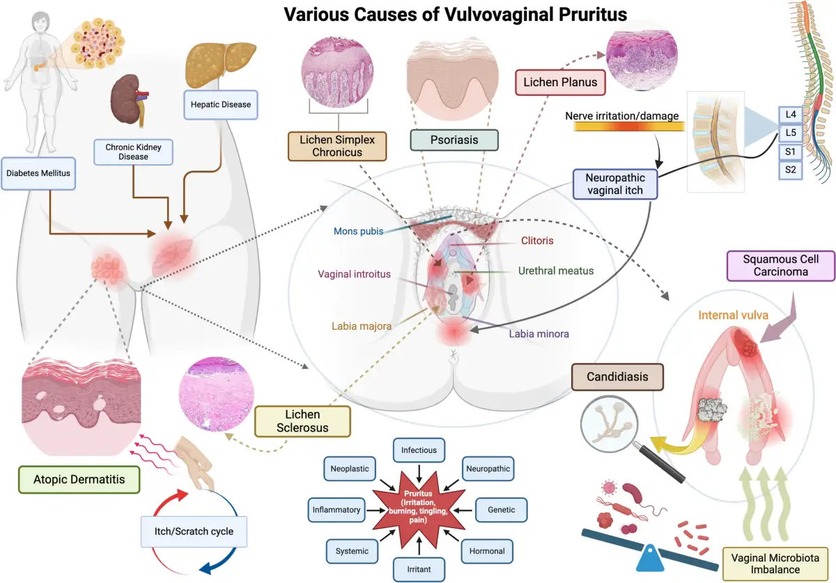 Diagrama de causas del prurito vulvovaginal, incluyendo diabetes, enfermedad hep&aacute;tica, psoriasis, candidiasis y desequilibrio de la microbiota, que pueden causar **picor &iacute;ntimo**.