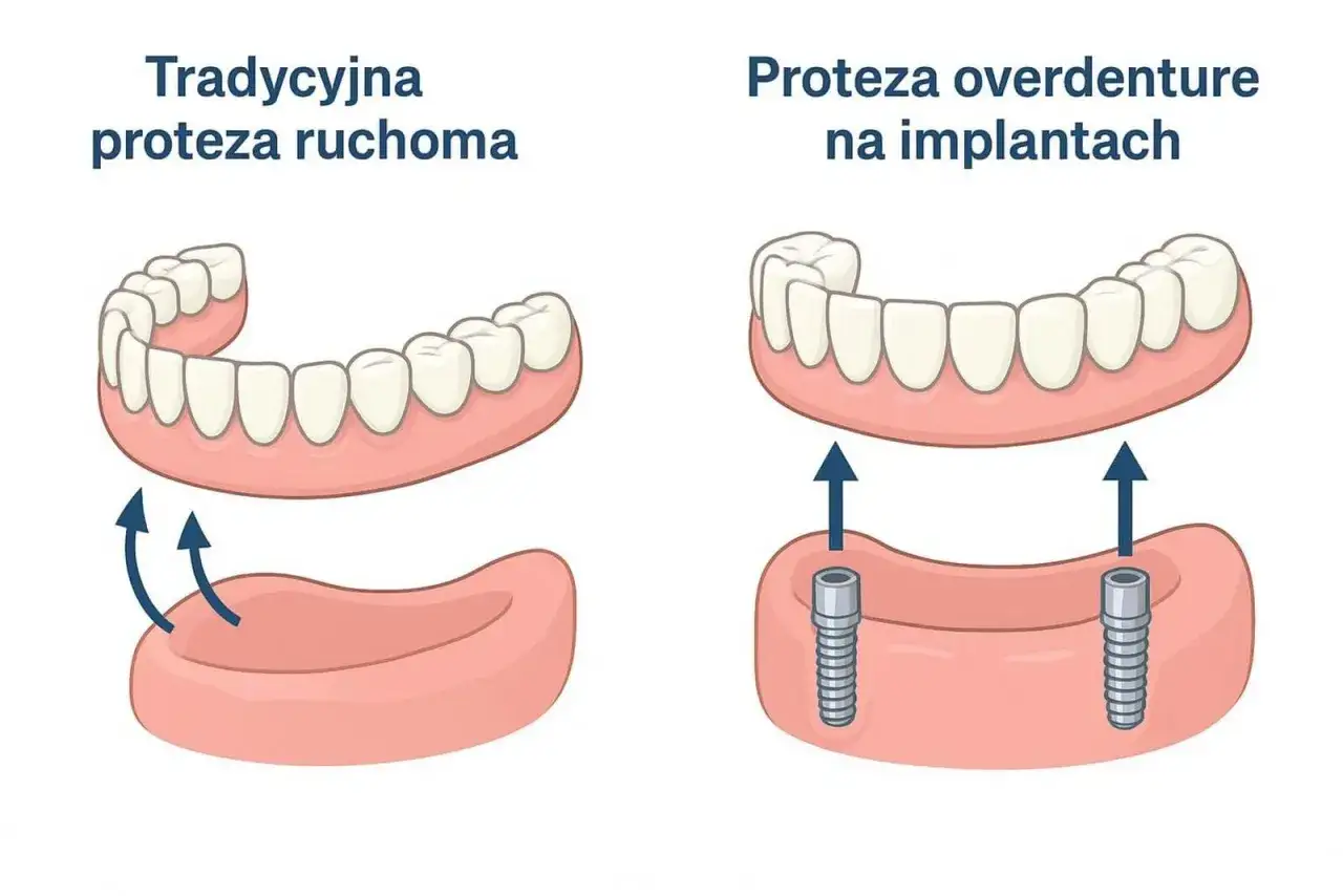 Porównanie tradycyjnej protezy ruchomej z protezą overdenture na implantach. Proteza natychmiastowa na NFZ to rozwiązanie dla Ciebie.
