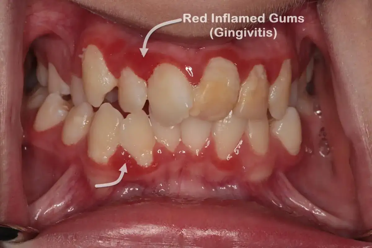 Encías rojas e inflamadas, señal de la gingivitis. Se observa la irritación alrededor de los dientes.