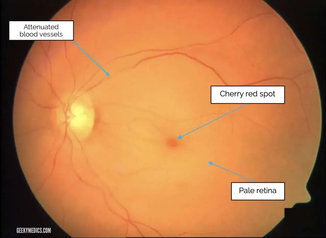 Occhio con macchia rosso ciliegia, retina pallida e vasi sanguigni attenuati, sintomi di trombosi oculare.