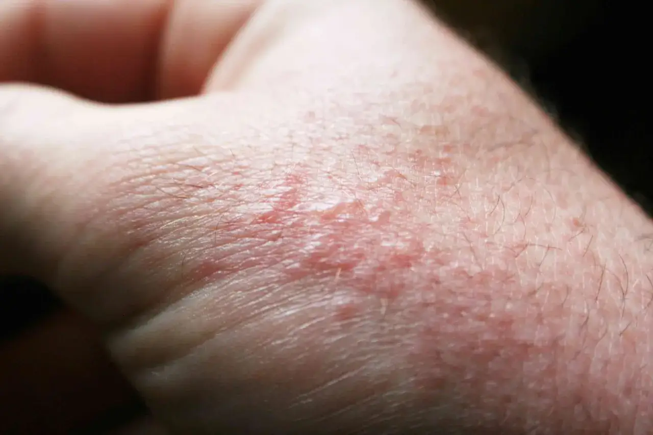 Pelle arrossata e irritata, con piccole vescicole, tipica della dermatite da sabbia nei bambini dopo una giornata al mare.