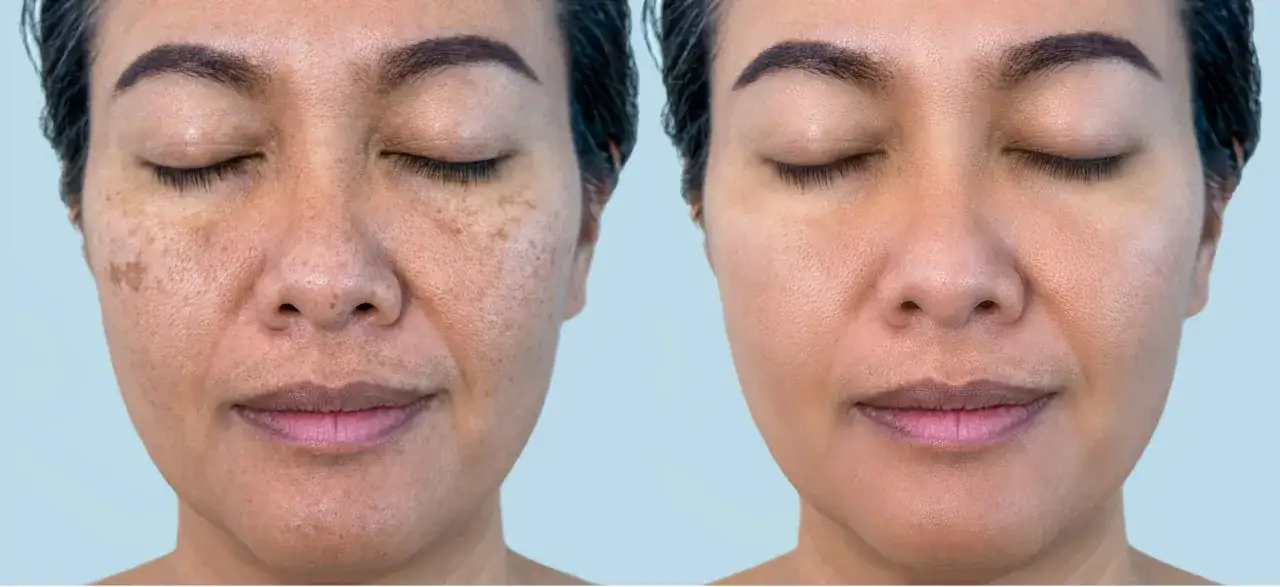 Vorher-Nachher-Vergleich: Deutliche Reduzierung von Melasma und Pigmentflecken, besonders auf der Oberlippe.