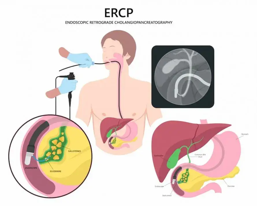ERCP Verfahren Galleng&auml;nge