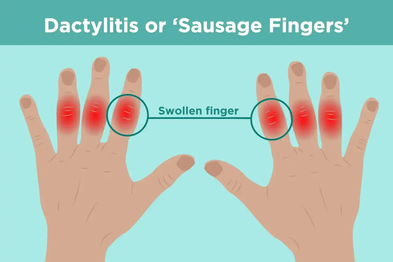 Illustrazione di mani con dita gonfie e arrossate, indicanti infiammazione dita mano, nota anche come 
