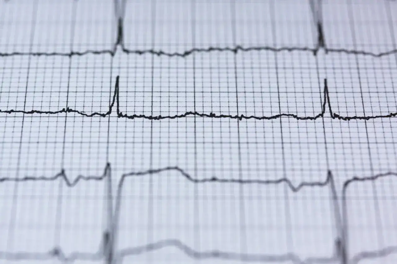 EKG pokazuje rytm serca. Czy nerwica serca wyjdzie na ekg? Zapis pokazuje fale, które mogą być interpretowane przez lekarza.