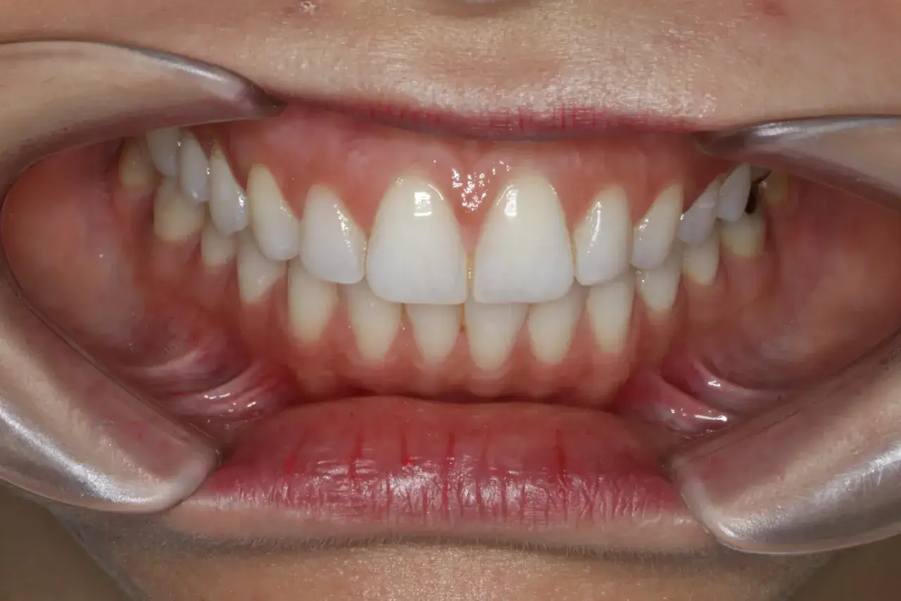 Boca abierta con dientes blancos y encías rosadas, lista para la revisión de un periodoncista que es un experto en salud bucal.