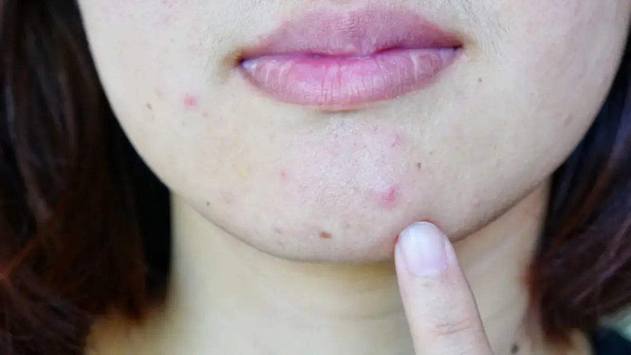 kiedy iść do dermatologa z pryszczami