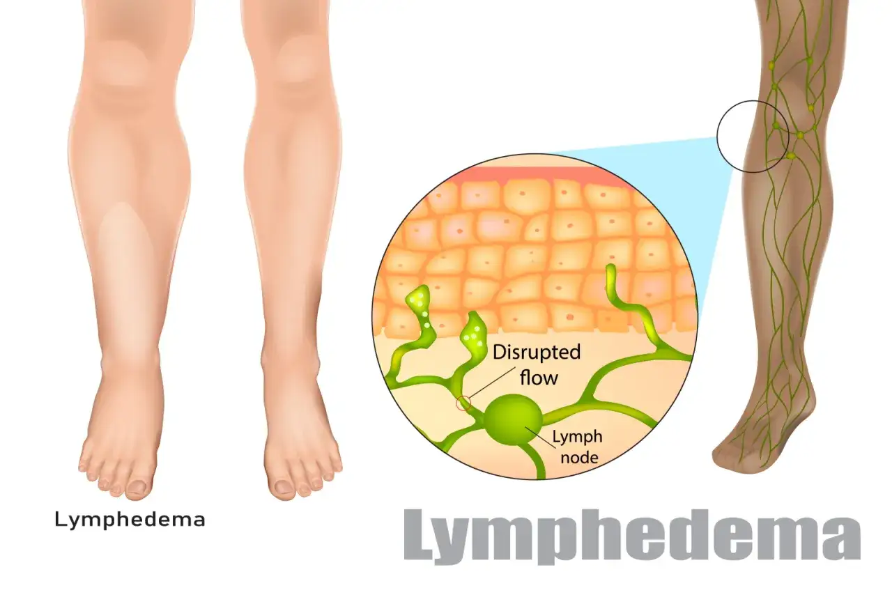 Ilustracja pokazuje obrzęk nóg (limfedema) spowodowany zaburzonym przepływem limfy. Widoczny jest powiększony węzeł chłonny i naczynia limfatyczne.