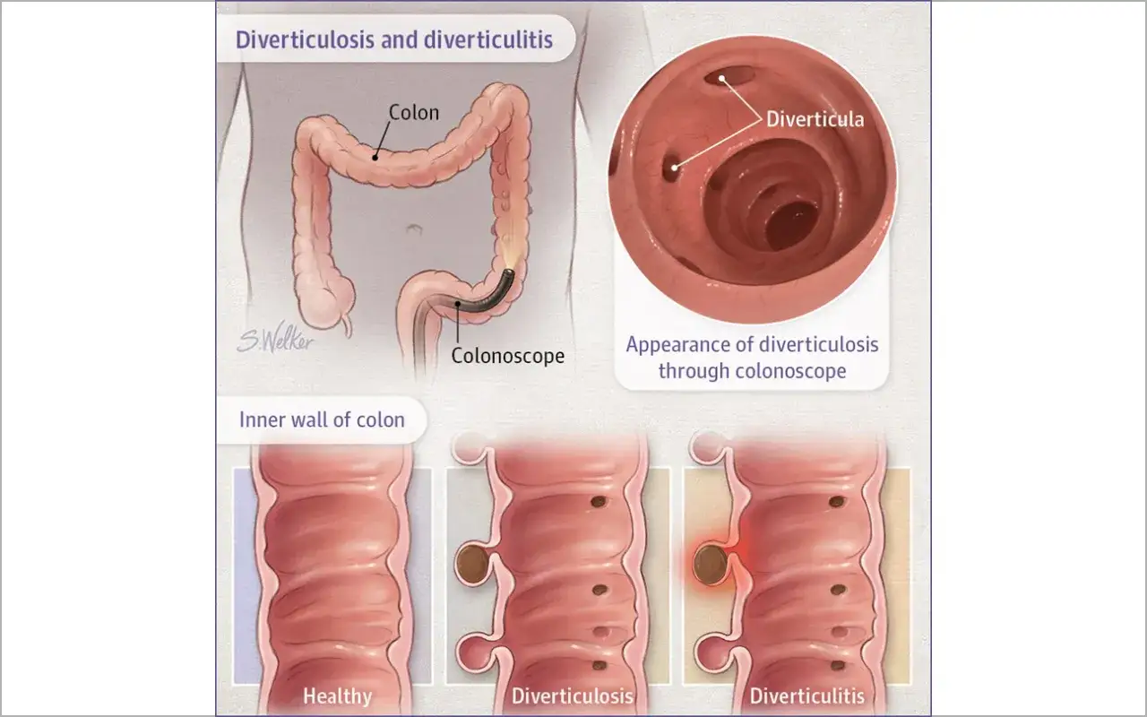 Ilustracja pokazuje uchyłki jelita grubego: zdrowe jelito, uchyłki (diverticulosis) i zapalenie uchyłków (diverticulitis) widziane podczas kolonoskopii.