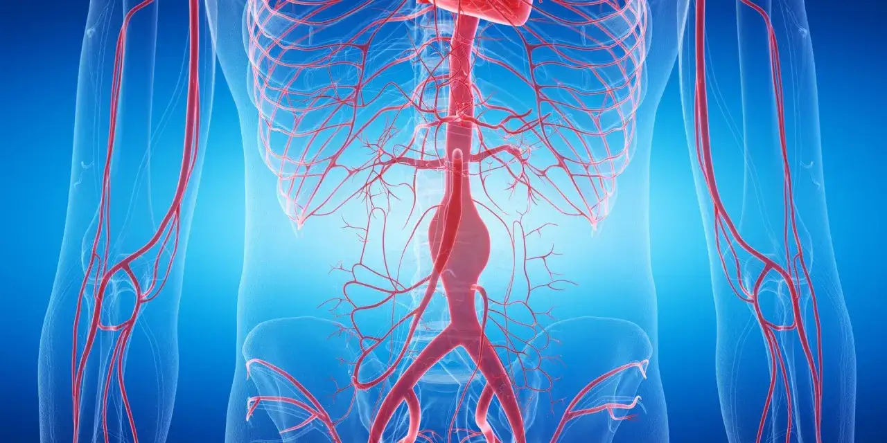 Widok anatomiczny układu krwionośnego z widocznym tętniakiem aorty brzusznej.