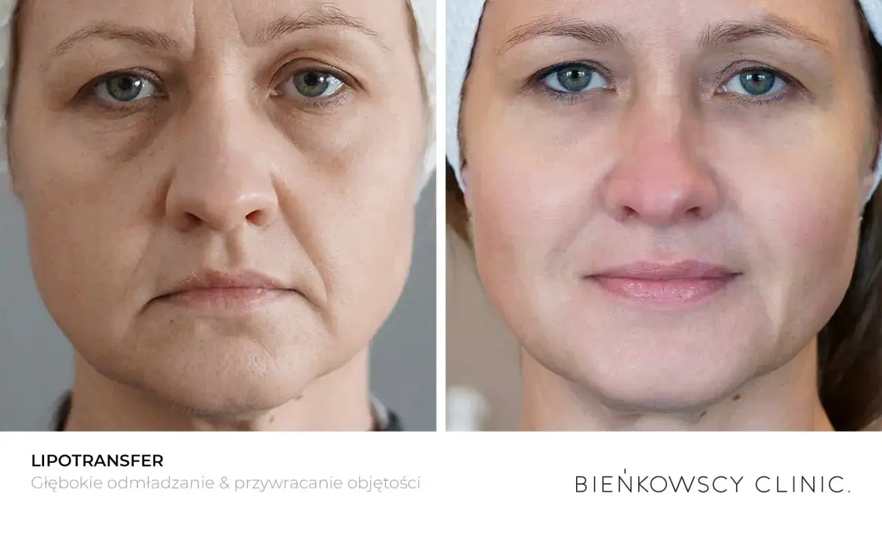 Przed i po lipotransferze twarzy: głębokie odmłodzenie i przywr&oacute;cenie objętości.