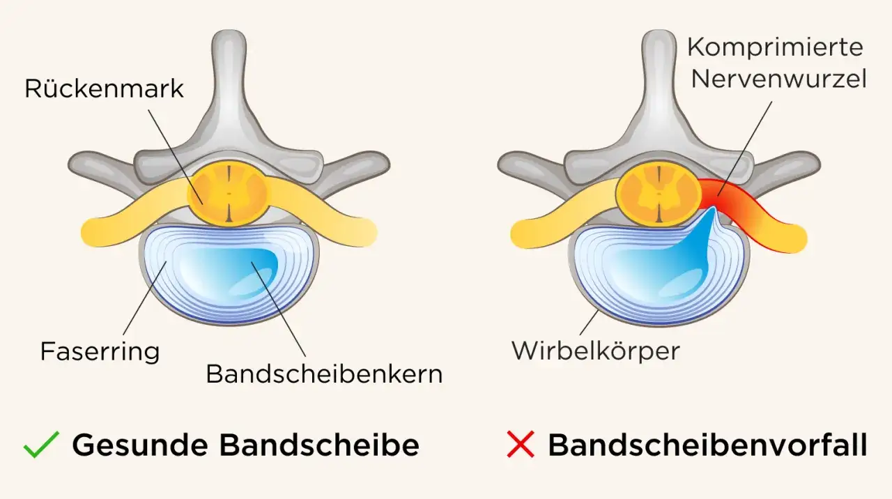 Vergleich: Gesunde Bandscheibe vs. Bandscheibenvorfall BWS. Ein Bandscheibenvorfall komprimiert Nervenwurzeln, was zu Symptomen f&uuml;hren kann.